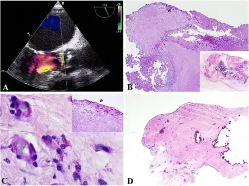 Calcific Valvular Degeneration