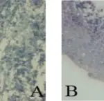 Calcifying Cystic Odontogenic Tumor