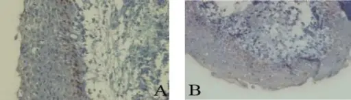 Calcifying Cystic Odontogenic Tumor