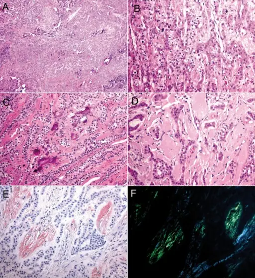 Calcifying epithelial odontogenic tumor (Pindborg tumor)