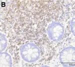 Campylobacter Enterocolitis