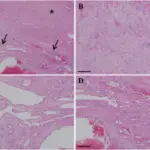 Capillary Hemangiomas