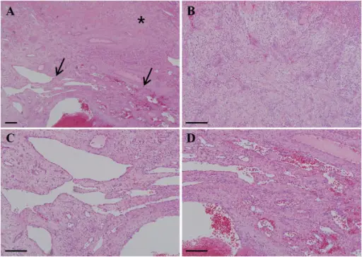 Capillary Hemangiomas