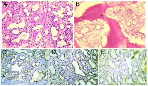 Capillary Hemangiomas