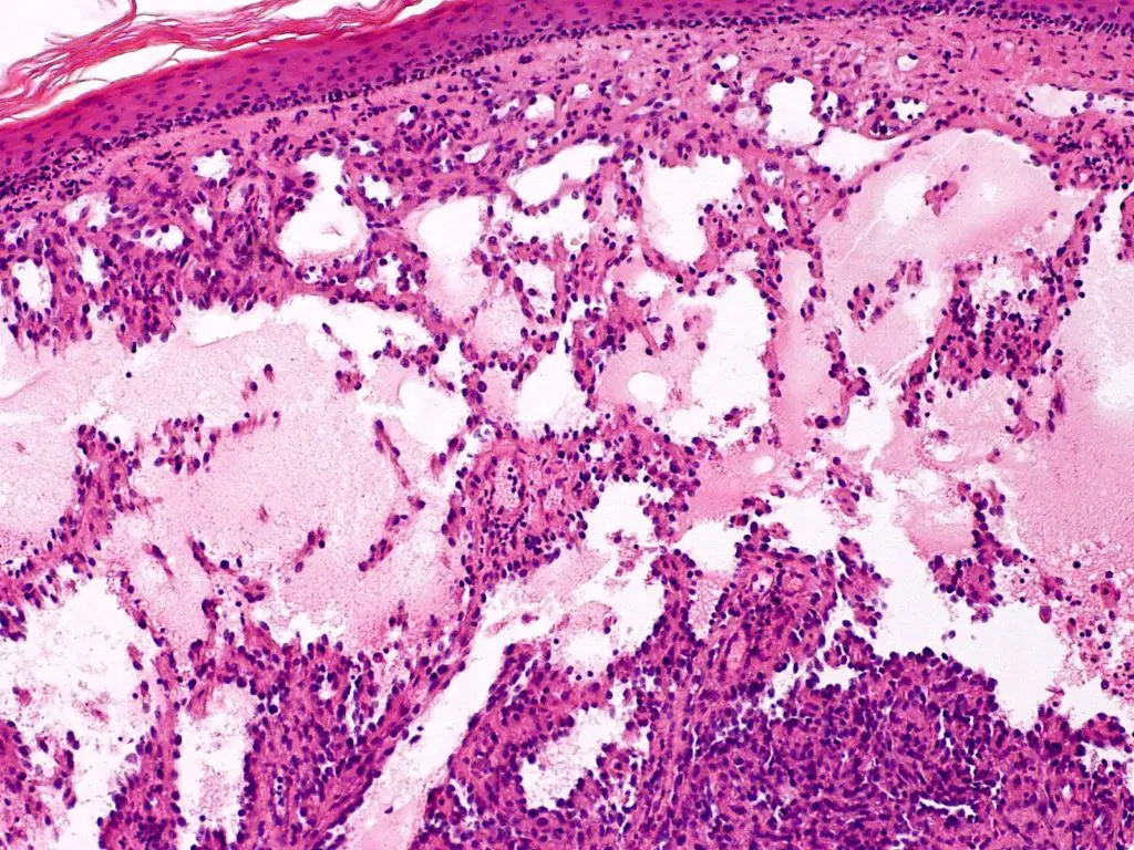 Capillary Lymphangiomas