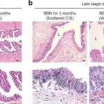 Carcinoma in Situ of the Bladder