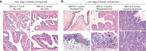 Carcinoma in Situ of the Bladder