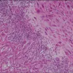 Carcinoma in Situ of the Penis