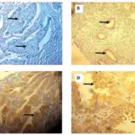 Carcinoma of the Endometrium