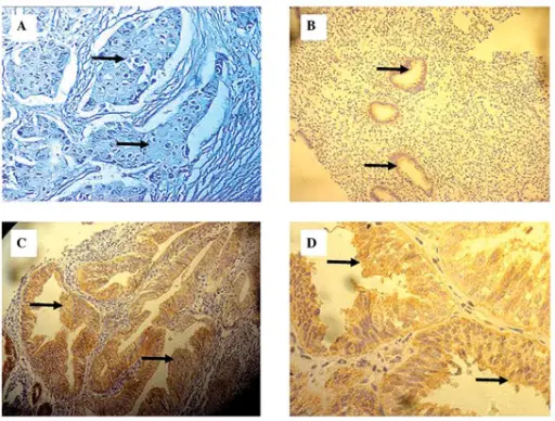 Carcinoma of the Endometrium