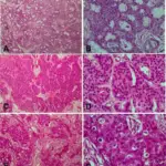 Carcinomas of the Breast