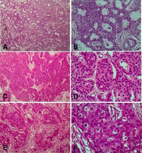 Carcinomas of the Breast