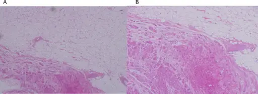 Cardiac Lipoma