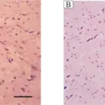 Cardiac Myxoma