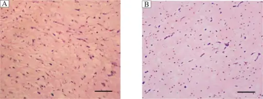 Cardiac Myxoma