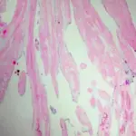 Cardiac Papillary Fibroelastoma