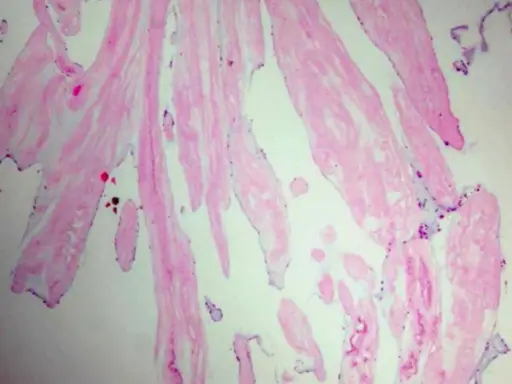 Cardiac Papillary Fibroelastoma