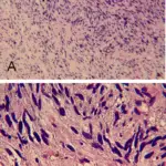 Cardiac Sarcoma