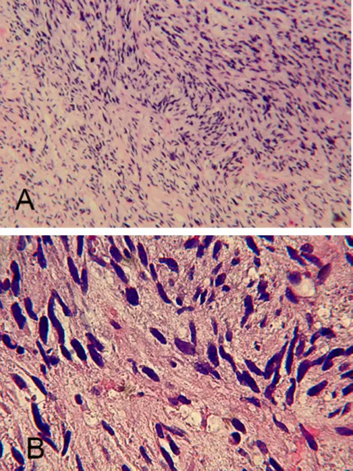 Cardiac Sarcoma