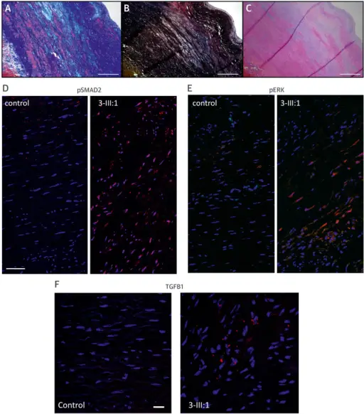 Cardiovascular Pathology