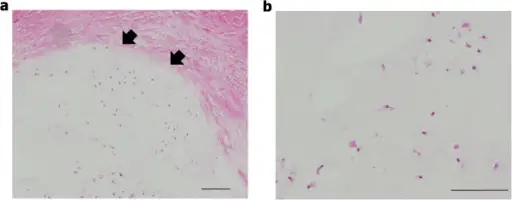 Cartilage Tumors