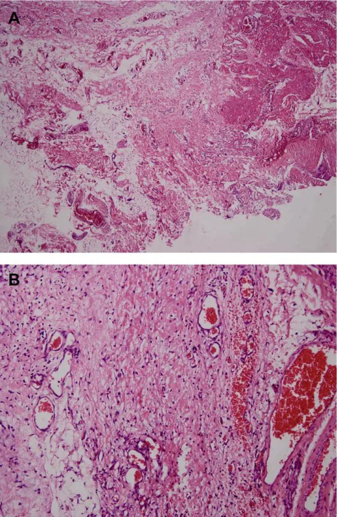 Cavernous Lymphangioma