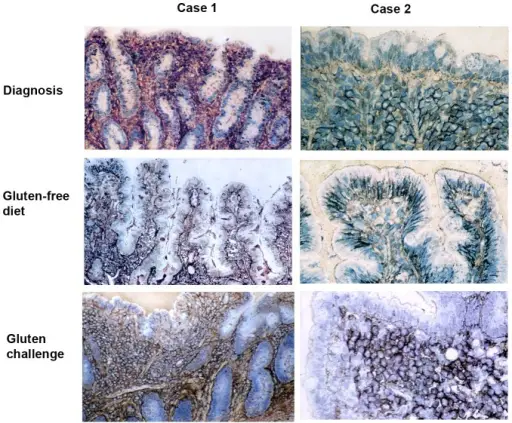 Celiac Disease