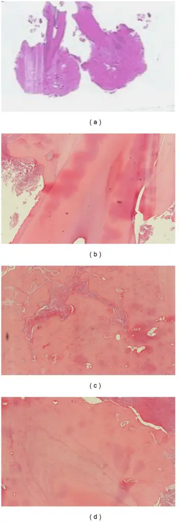 Cementoblastoma