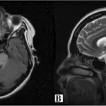 Central Pontine Myelinolysis