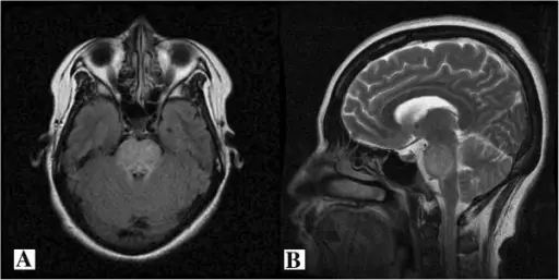 Central Pontine Myelinolysis