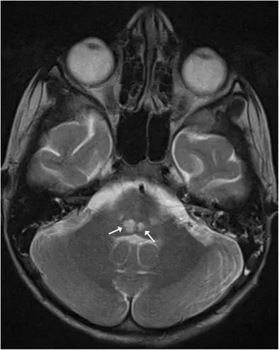 Cerebral Palsy