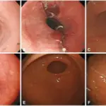 Chemical Esophagitis