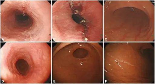 Chemical Esophagitis