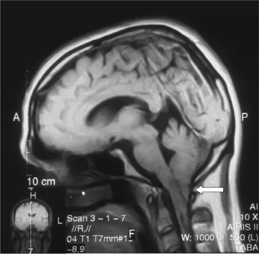 Chiari Type I Malformation