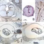 Chiari Type II Malformation