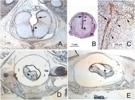 Chiari Type II Malformation