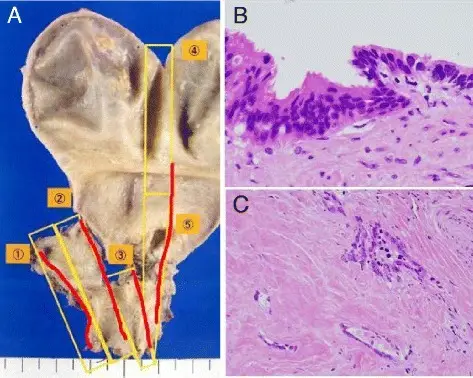 Cholangiocarcinoma