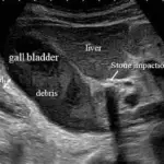 Cholecystitis