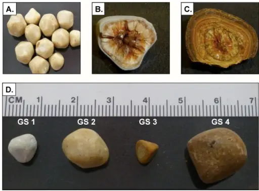 Cholelithiasis