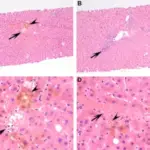 Cholestasis