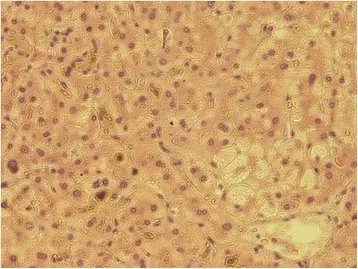 Cholestasis of Sepsis