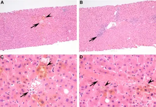 Cholestasis