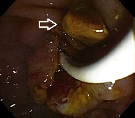 Cholesterol Stones