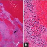 Choriocarcinoma