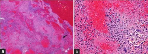 Choriocarcinoma