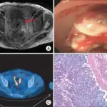 Choriocarcinoma