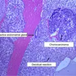 Choriocarcinoma of the Ovary