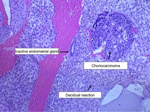 Choriocarcinoma of the Ovary