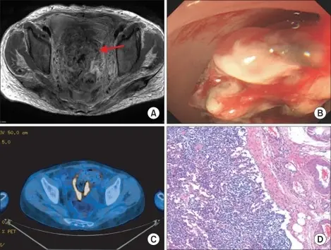 Choriocarcinoma