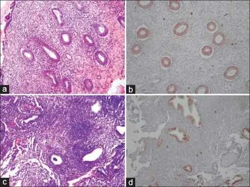 Chronic Endometritis